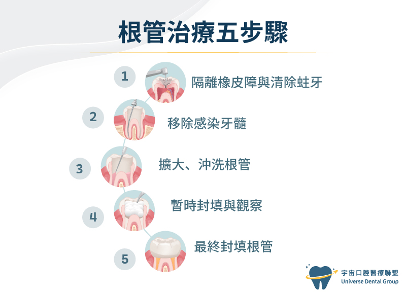 根管治療流程-根管治療五步驟